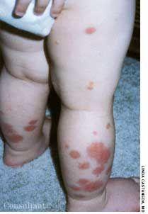 Toddler With Henoch-Schönlein Purpura