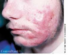 Refractory Acne Vulgaris in a 16-Year-Old Boy