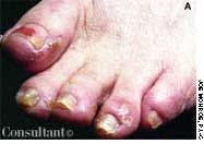 Tinea Pedis and Reactive Eruptions