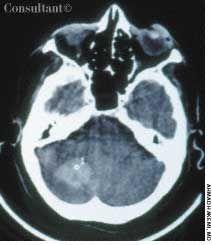 Cerebellar Hemorrhage in a 65-Year-Old Woman