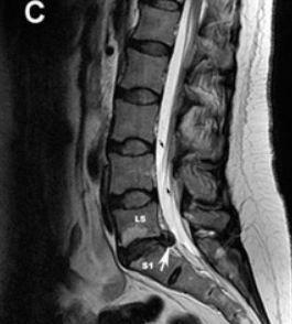 Oral Steroids for Acute Radiculopathy?