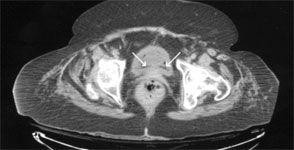 Emphysematous Cystitis