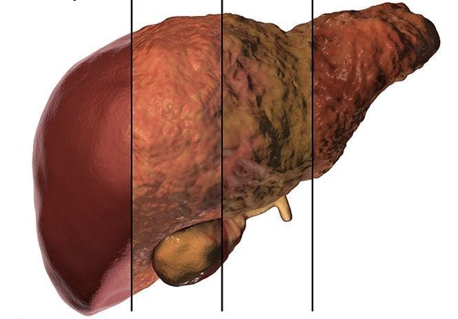 ©Kateryna_Kon/Adobe Stock   In Patients with NAFLD, Type 2 Diabetes Significantly Ups Risk for Hepatic Decompensation, Hepatocellular Carcinoma