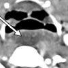 Retropharyngeal Abscess