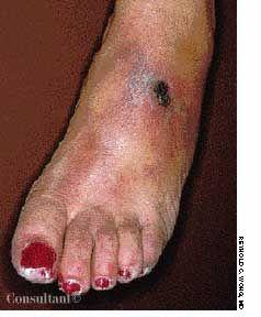 Superficial Thrombophlebitis