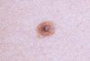 “Fried Egg” Nevus That Resembles a Melanoma