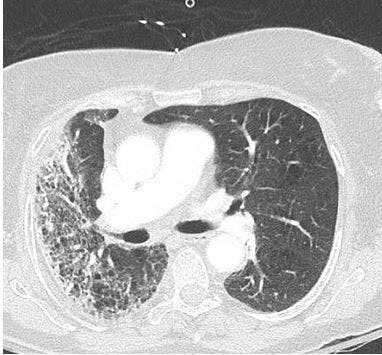 Progressive Pulmonary Symptoms in an Elderly Woman 