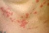 Go For The Glory Quiz: Rash a Complication of Nipple Piercing?