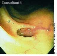 Diverticulosis in an Elderly Woman