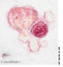 Pyoderma Gangrenosum Surrounding Colostomy Stoma in a 64-Year-Old Woman With Crohn Disease