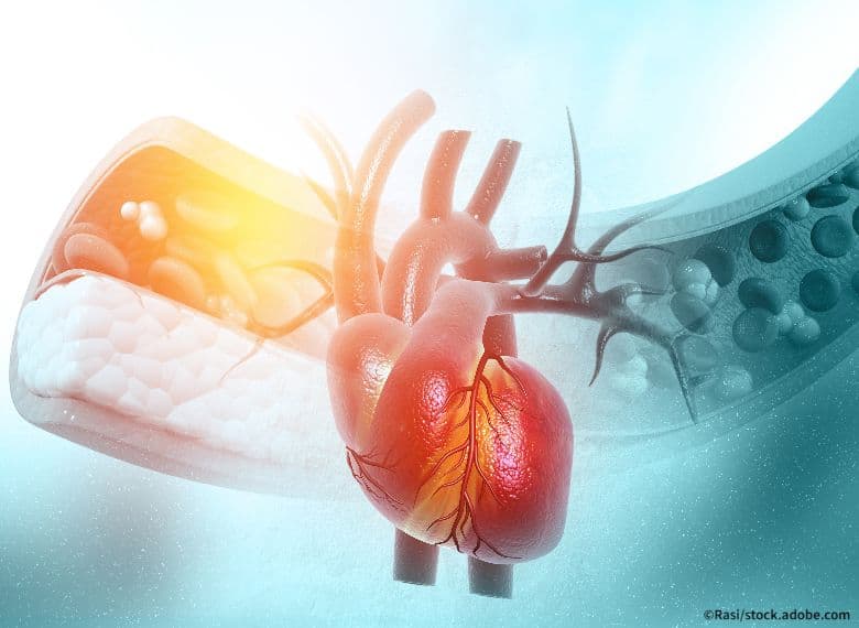 Cholesterol blocked artery with heart