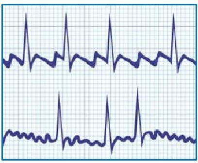 Atrial fibrillation, atrial flutter, anticoagulation