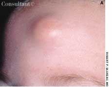 Pilomatrixoma in an Infant 