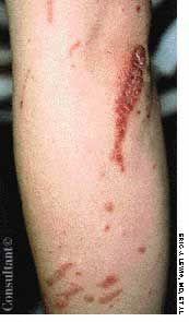 Psoriasis: Koebner's Phenomenon and Woronoff's Ring