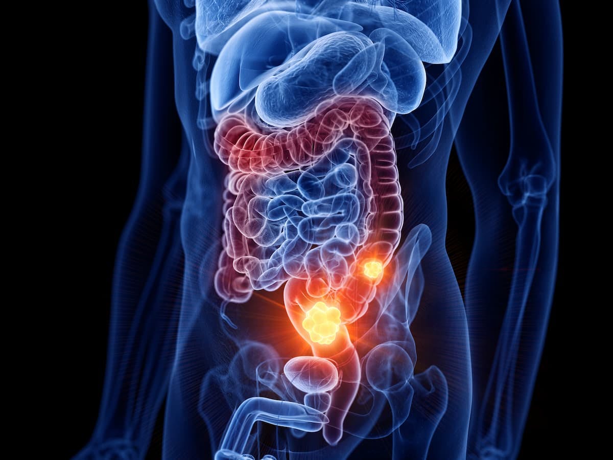 Colorectal Cancer Incidence Has Increased Among Men, Not Women, According to Recent Study / Image credit: ©SciePro/AdobeStock