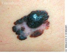 Malignant Melanoma in a Patient withMulti-organ Metastatic Disease