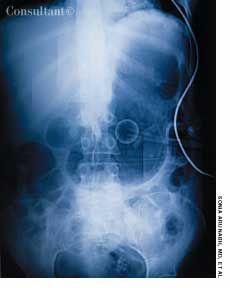 Acute Dilatation of the Stomach