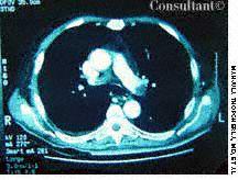 Pulmonary Embolism