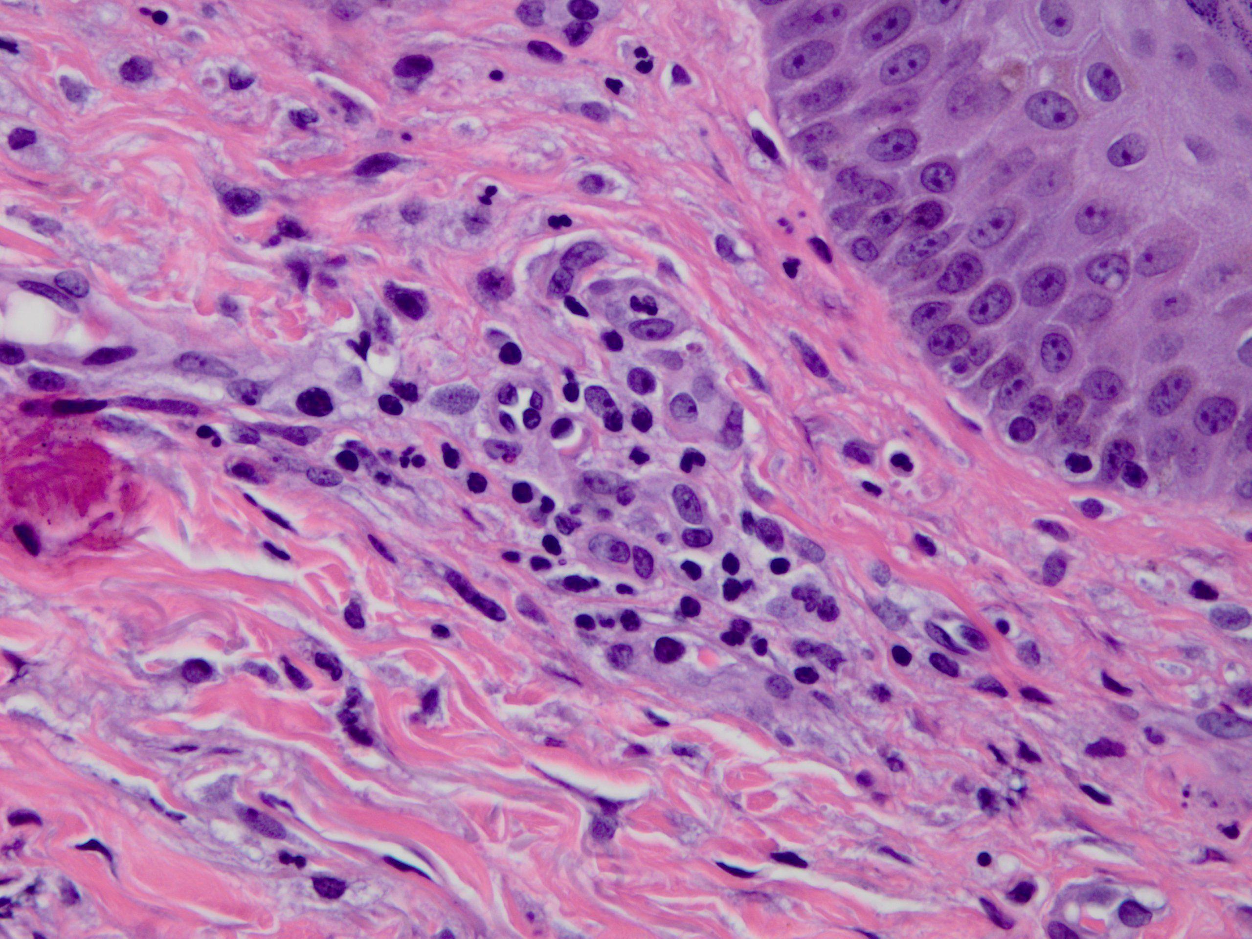 cutaneous leukocytoclastic vasculitis 