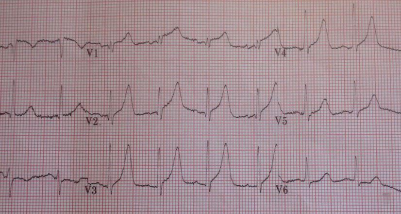 Managing acute coronary syndrome 