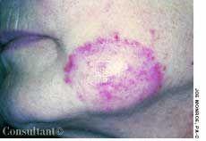 Majocchi Folliculitis