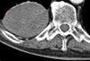 Solitary Fibrous Tumor of the Pleura