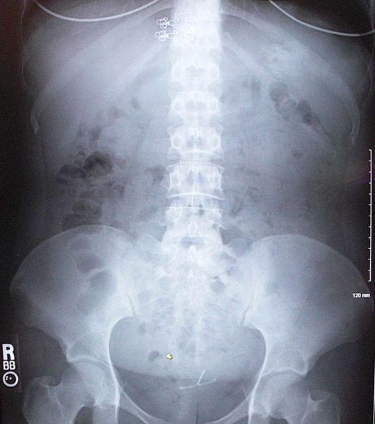 Phytobezoar related to diabetic gastroparesis. 