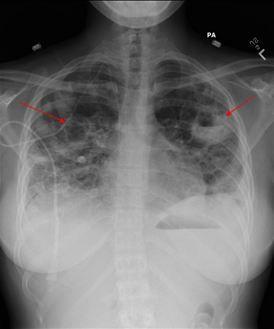 Lemierre syndrome