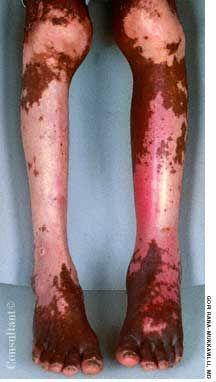 Vitiligo and Cellulitis