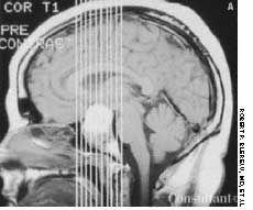 Pituitary Macroadenoma With Hemorrhage