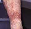 Chronic Venous Insufficiency