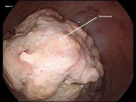 Gastric Phytobezoar: A Case Report