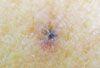 Traumatic Tattoo: A Melanoma Mimic