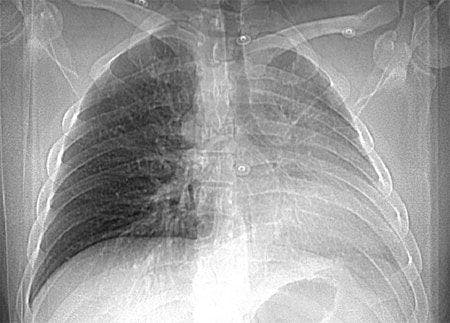 A Man With Transient Dyspnea After Taking Tadalafil