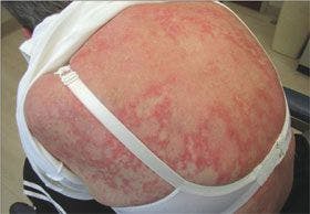 Subacute Cutaneous Lupus Erythematosus