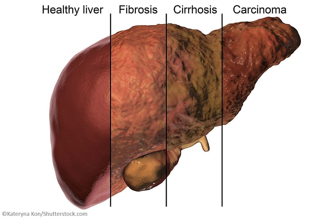 HCV/HIV-coinfected Patients Recover Liver Function with All-oral DAA Therapy  