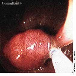 Colonic Adenoma