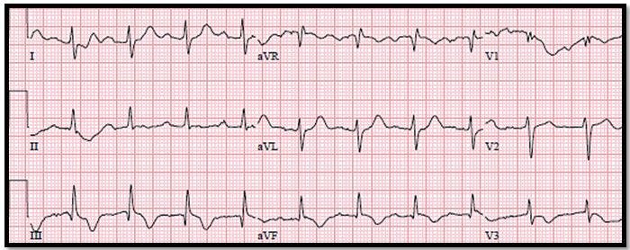 Pulmonary embolism