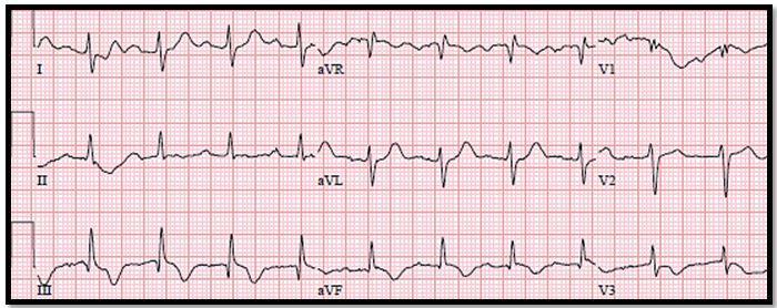 Hypoxia in an Elder 