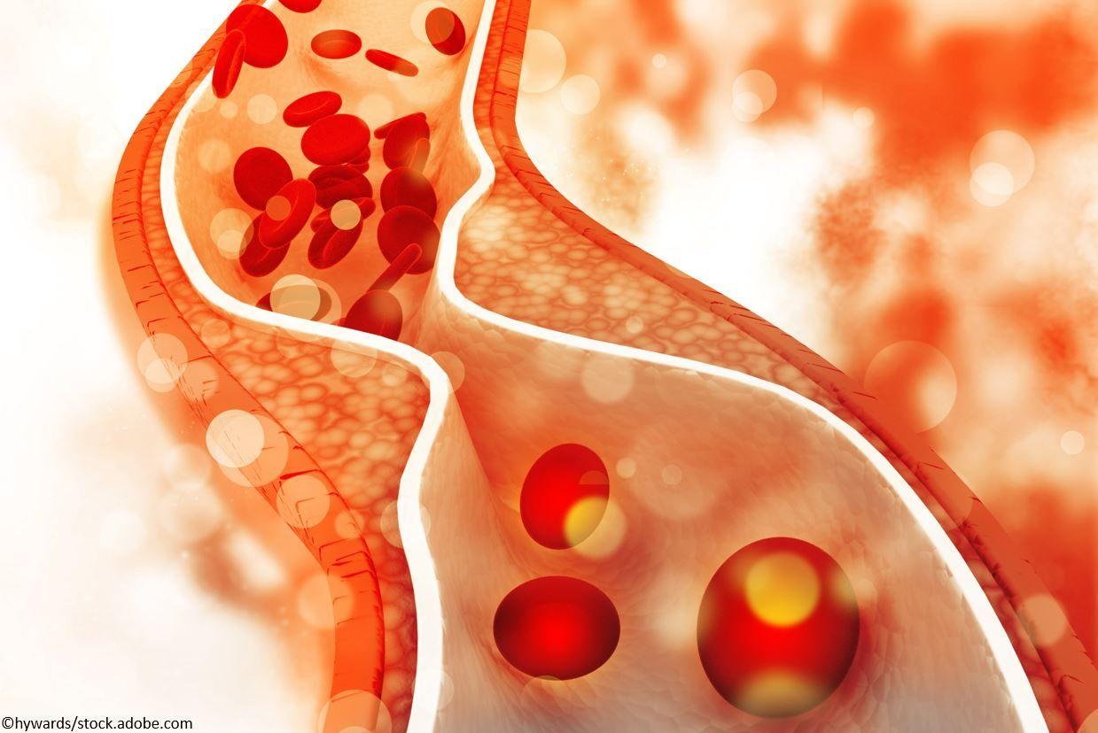 Cholesterol plaque in artery, stroke, heart attack, artery, CVD, cardiovascular