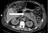 Emphysematous Pancreatitis in a 61-Year-Old Man