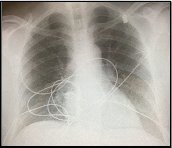 Anxiety, dyspnea, hypoxia 