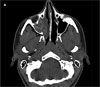 Allergic Fungal Sinusitis