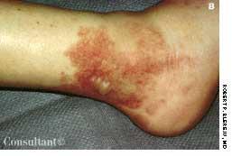 Leukocytoclastic Vasculitis