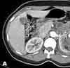 Renal Angiomyolipoma