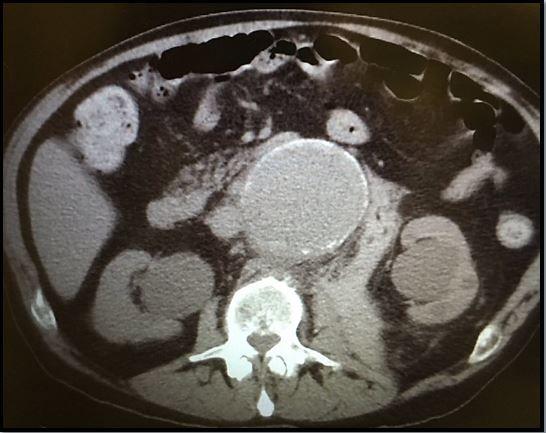 Back Injury, Shortness of Breath in an Older Man 