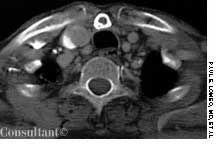 Episternal Ossicle