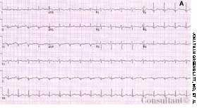 Rate-Related Septal Infarct Pattern