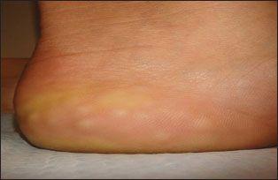 Piezogenic Pedal Papules