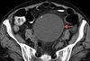 A Rare Retroperitoneal Pseudocyst in a Woman With Ulcerative Colitis